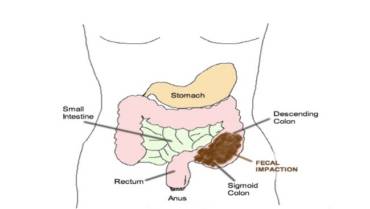 Is Colonic Inertia Causing Your Constipation?