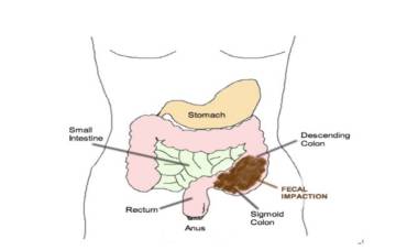 Is Colonic Inertia Causing Your Constipation?