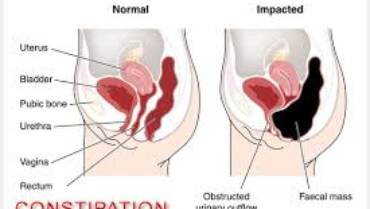Constipation and Bladder Incontinence Can Go Hand in Hand
