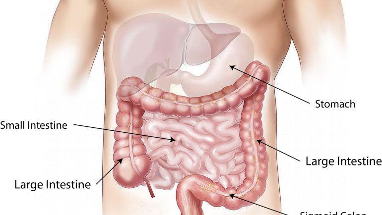 Ulcerative Colitis – It Can Be A Pain In The Butt!